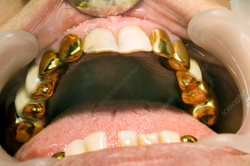 Gold Crowns
