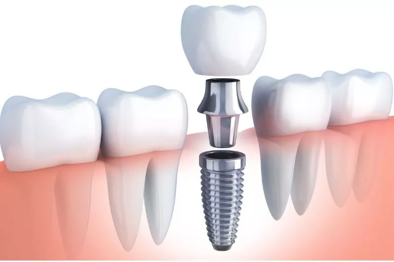 croasdaile dental arts dental implants