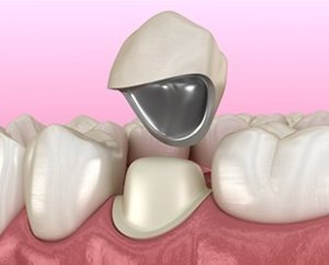 Metal Fused With Proclain