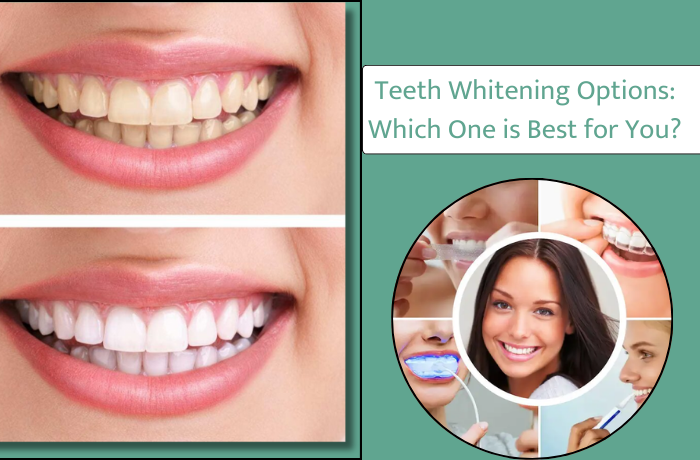 teeth whitening options which one is best for you