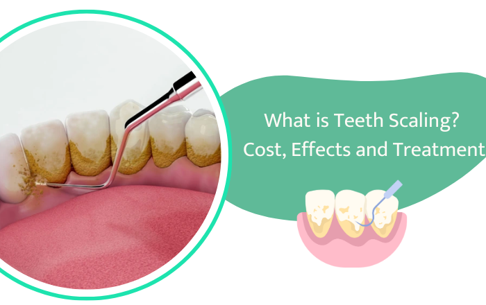 what is teeth scaling cost effects and treatment