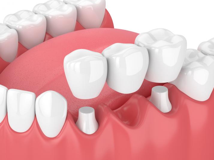 dental crown implants