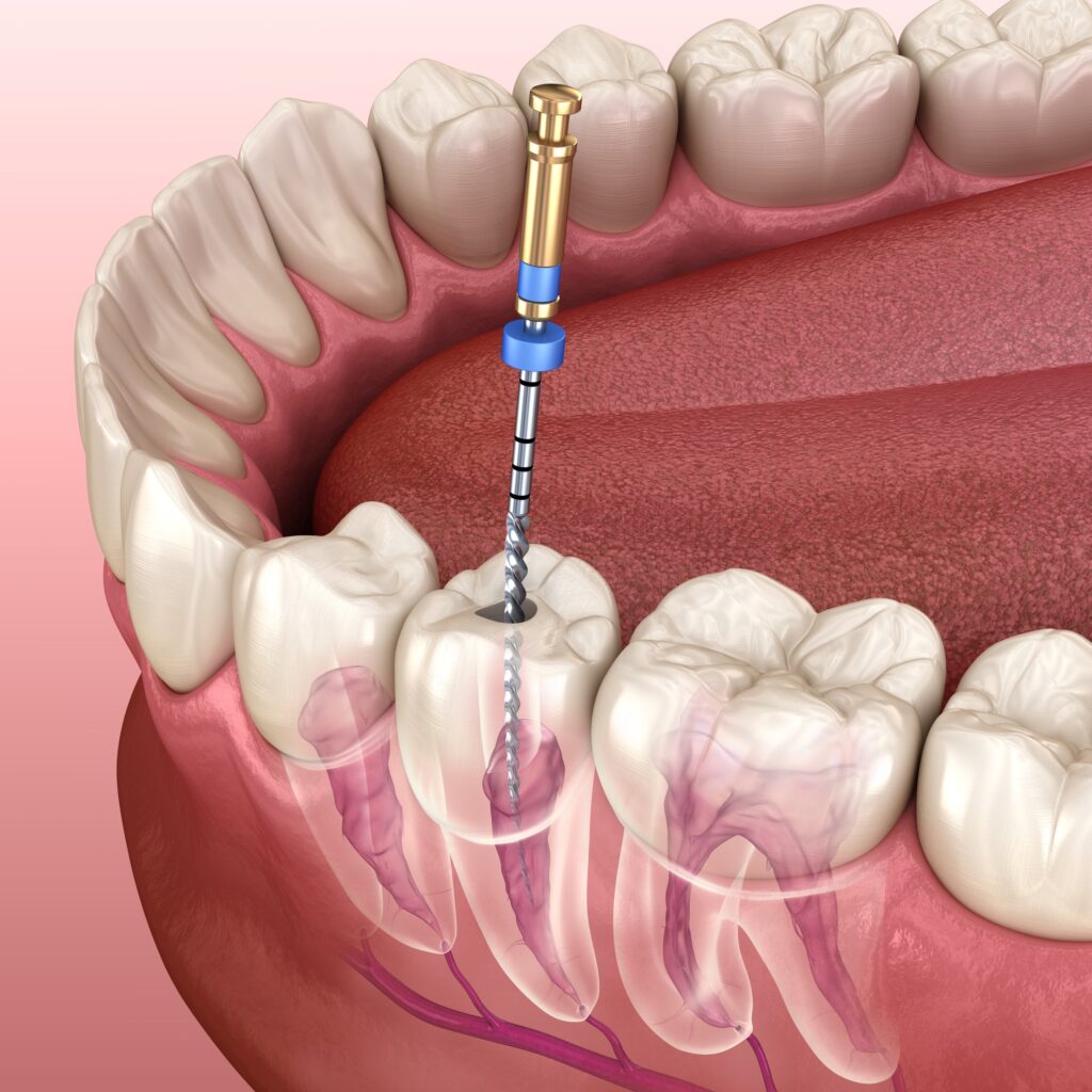 dental root canal 1024x1024