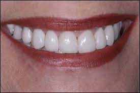 Procera Crowns