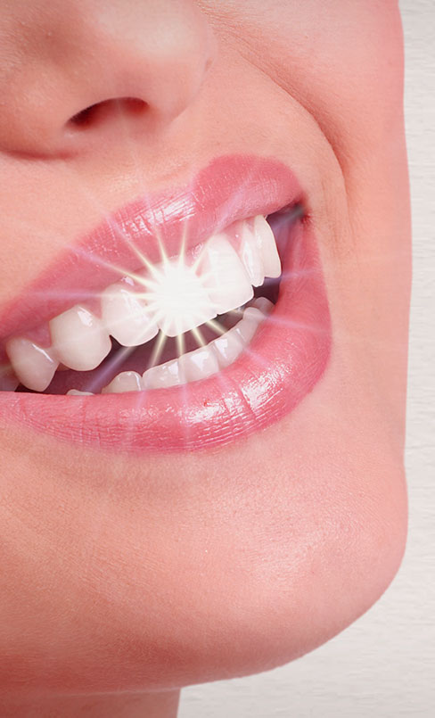 teeth whitening img