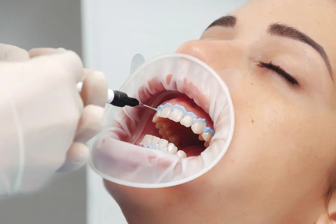 understanding the process of teeth whitening 04