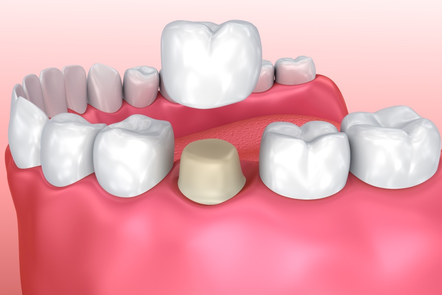 dentalcrown900x600