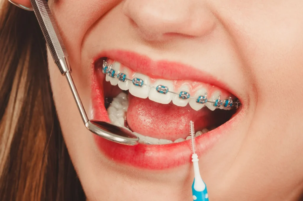 choosing the right type of braces
