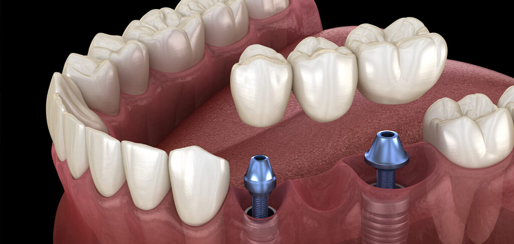 dental implants in south delhi banner the dental roots 1