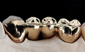 Metal Crowns