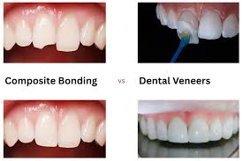Composite Bonding vs Veneers images (88)