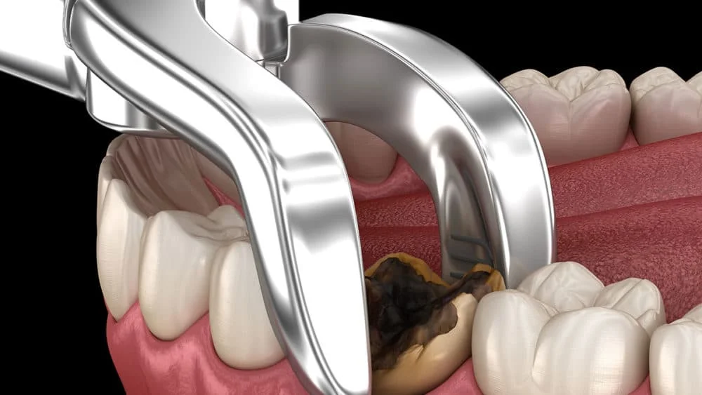 tooth extraction 1000x563 1